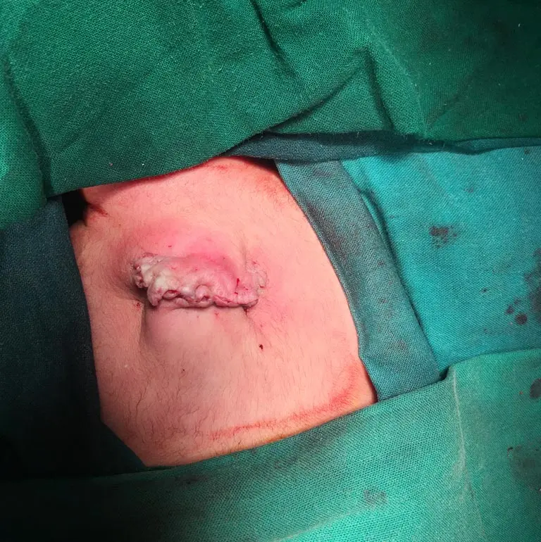Thoracic meningomyelocele post surgery
