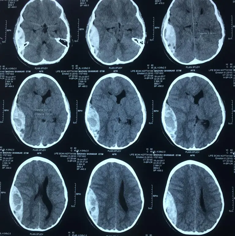 Preoperative brain CT scan