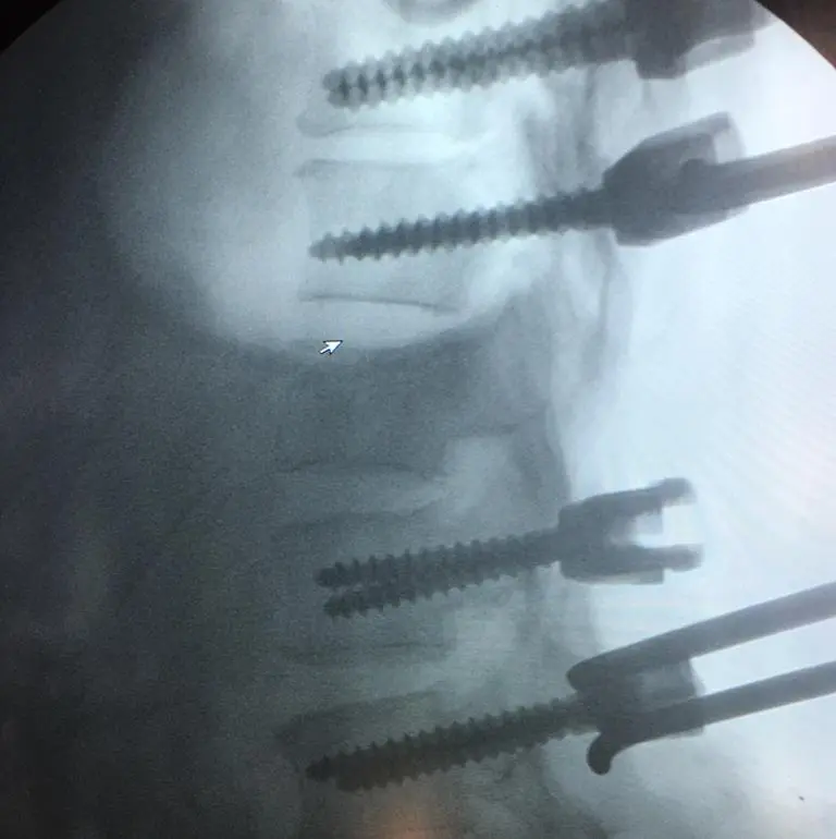 Spine stabilization in a 65 yr old male