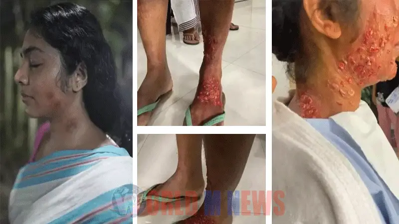 പ്രാണി 'കടിച്ച' റിമയുടെ ശരീരം : പ്രോസ്തറ്റിക് മേക്കപ്പ് വീഡിയോ പങ്കുവെച്ച് സേതു ശിവാനന്ദൻ