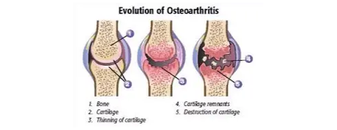OsteoArtritis