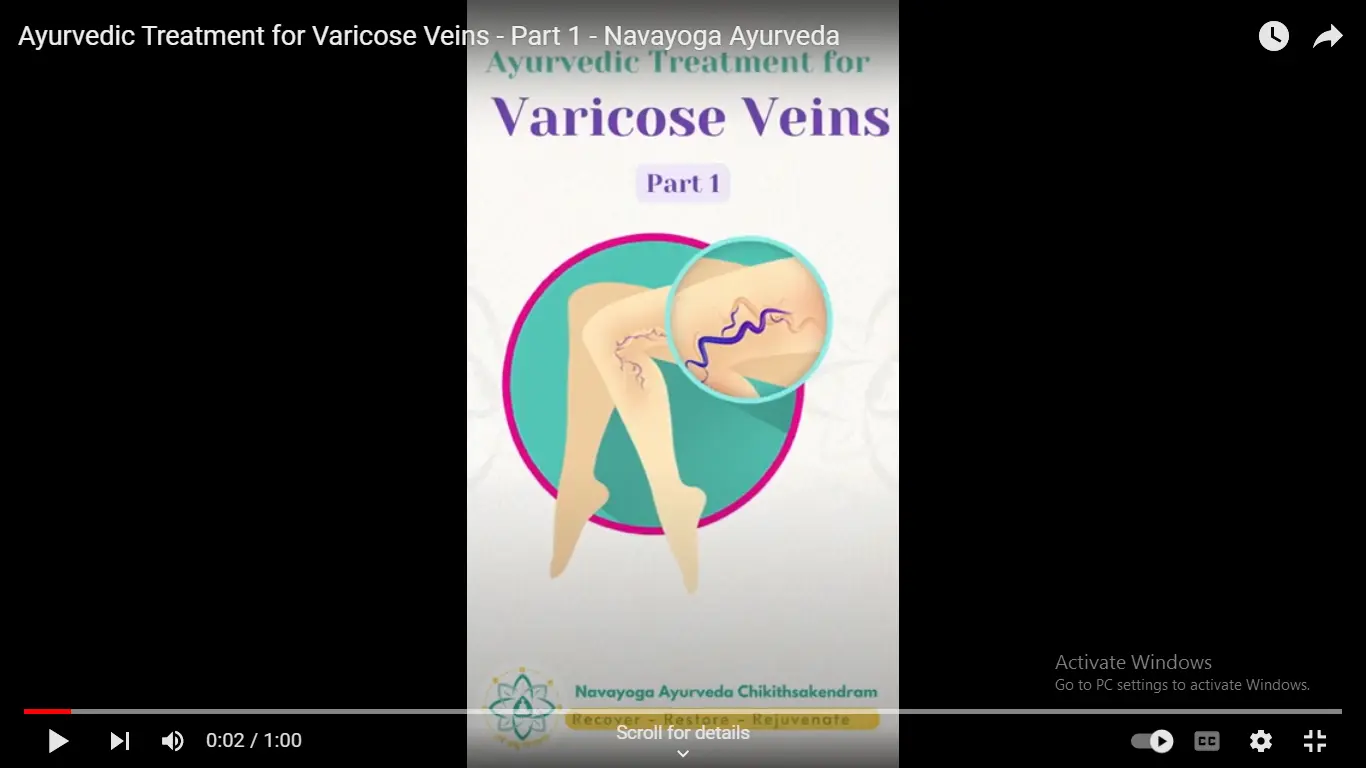 Ayurvedic Treatment for Varicose Veins - Part 1